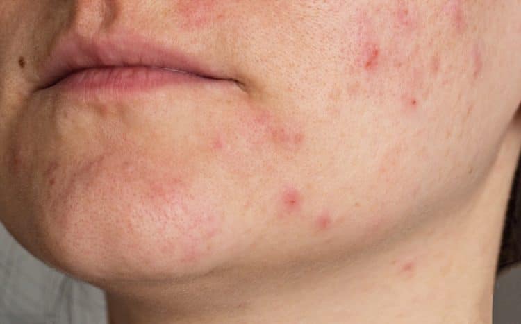acne